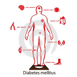 Complications of Diabetes Mellitus in fat people. Illustration in Infographic style about medical and health.