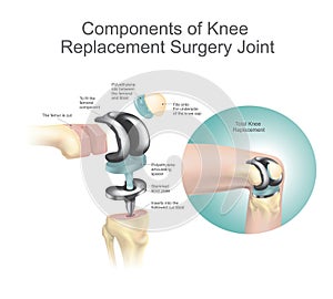 Components of knee replacement surgery joint. photo