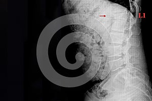 Compression fracture of L1 spine