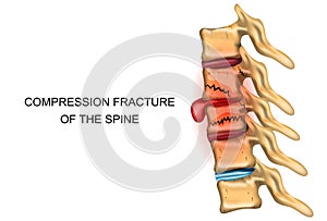 Compression fracture of the spine