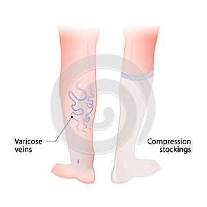 Compression stockings for varicose veins photo