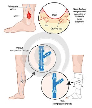 Compression therapy for leg ulcers