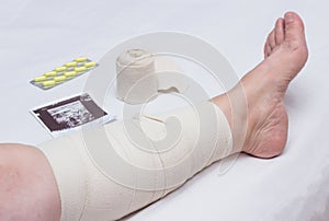 Compression therapy for varicose veins in a woman`s legs, treatment of varicose veins with an elastic bandage, vascular