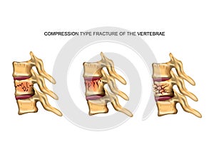 Compression type fracture of the spine photo