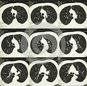 Computed body tomography of chest