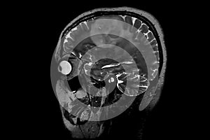 Computed resonance imaging of the human brain.