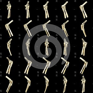 Computed tomogram of bone fracture photo