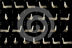 Computed tomogram of bone fracture photo