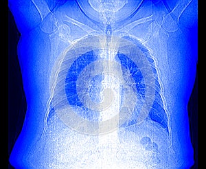 Image of a computed tomogram  the lung with viral polysigmentary pneumonia photo