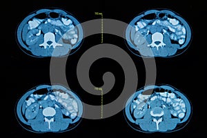 Computed tomography of the abdominal.