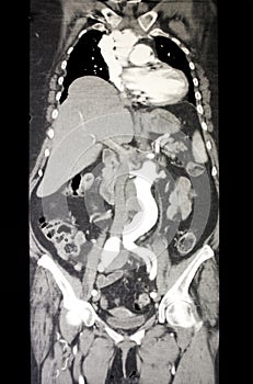 Computed Tomography of body (CT)