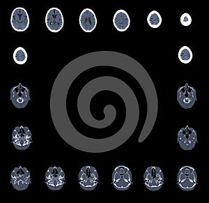 Computed tomography brain photo