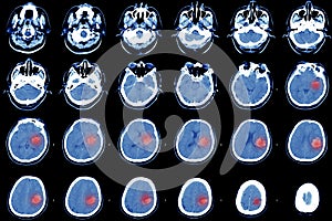 Computed tomography of the brain, hemorrhagic stroke.