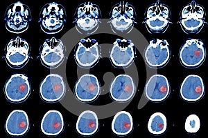 Computed tomography of the brain, hemorrhagic stroke. photo