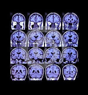 Computed Tomography of Braincase - Central Nervous System Medical Test