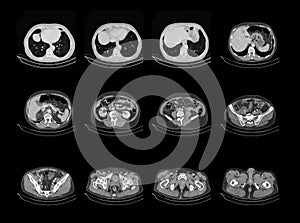 Computed tomography chest and abdomen