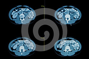 Computed tomography of the chest.