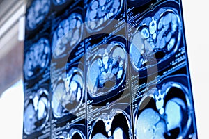Computed tomography (CT scan) of chest with abdomen