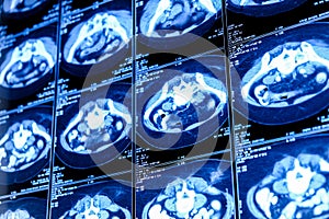 Computed tomography (CT scan) of chest with abdomen