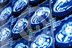 Computed tomography (CT scan) of chest with abdomen