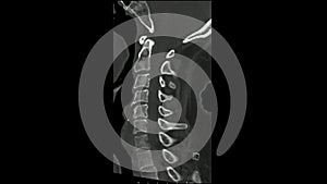 Computed Tomography examination of the Cervical spine  CT CS sagittal in cine mode