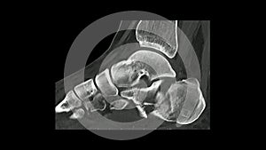 Computed Tomography  of the  foot in sagittal plane showing fracture of  calcaneum/ heel bone  CT Foot.