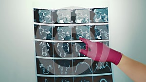 Computed tomography in the hands of a doctor close up. The CT scan doctor points to important and problematic areas on