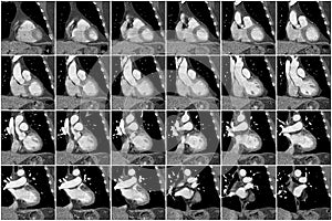 Computed tomography of the heart