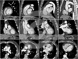 Computed tomography of the heart photo