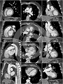 Computed tomography of the heart