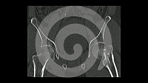 Computed Tomography  of the  pelvis in coronal plane showing left femur neck fracture  CT Pelvis.