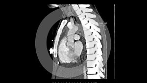 Computed Tomography of the pulmonary artery in Sagittal plane for diagnosis of pulmonary embolism