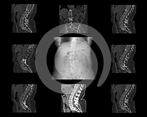 Computed tomography of the spine