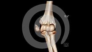 Computed Tomography Volume Rendering examination of the Elbow joint  CT VR Elbow showing fracture of the medial epicondyle photo