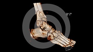 Computed Tomography volume rendering image CT VR  of fracture of the leg bones