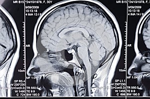 Computer axial tomography scan (CAT) of a head