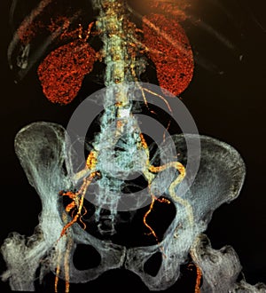 Computadora tomografía  tridimensional imágenes urología 