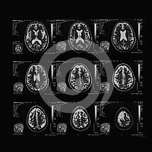 Computer tomography image of human brain regions. Black and white x-ray film