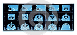 Computer tomography of maxillary sinus