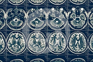 Computer tomography X-Ray brain scan image, internal hydrocephalus, neurology