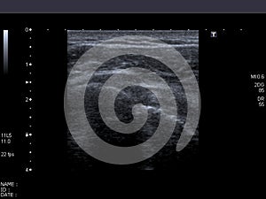 Computerized echography photo