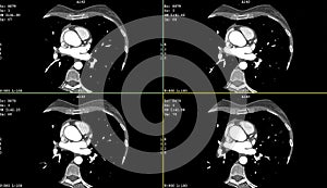 Computerized tomography CT coronary angiogram. Axial contrast of the cardio system of the heart