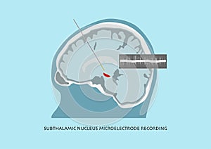 Concept of brain recording in subthalamic nucleus for Parkinson disease surgery