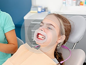 Concept of dental care. Enlarged image of ceramic and metal braces on teeth