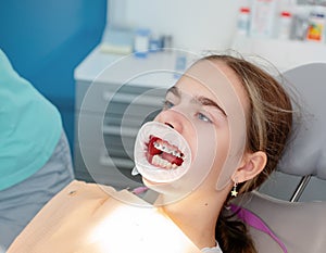 Concept of dental care. Enlarged image of ceramic and metal braces on teeth