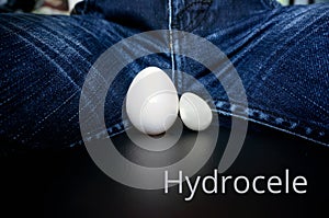 The concept of the disease hydrocele