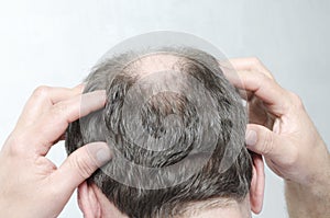 Concept of hair loss.Man doing a head massage as a treatment of receding