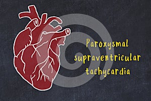 Concept of learning cardiovascular system. Chalk drawing of human heart and inscription Paroxysmal supraventricular tachycardia