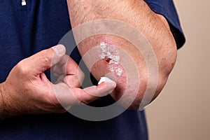 Concept photo of treatment of skin diseases using ointments as dosage form of drug. Patient causes medical therapeutic ointment