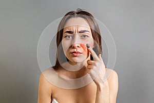 The concept of rosacea. A Caucasian brunette woman points a finger at a red cheek with inflammation. Copy space. Gray background